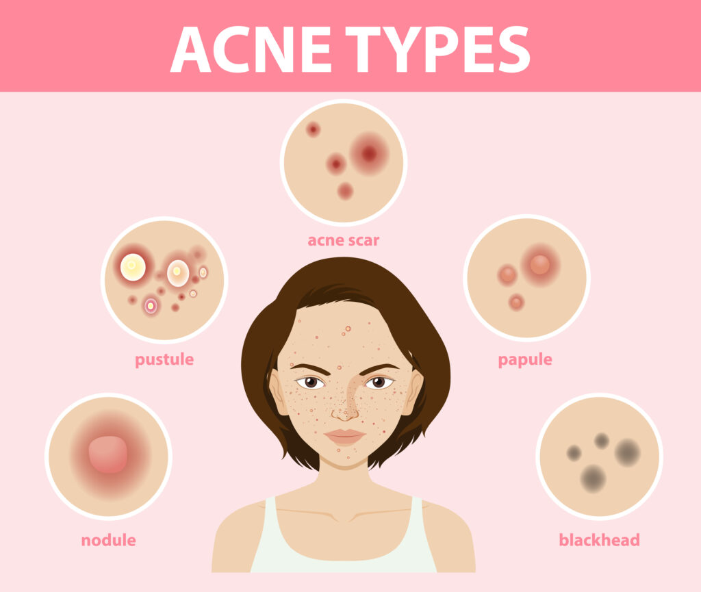 Best Anti-Acne Products: A Comprehensive Buyers Guide